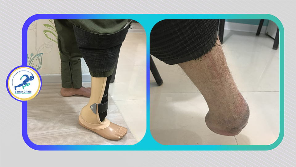 Imler Partial Foot Prosthesis IPFP—