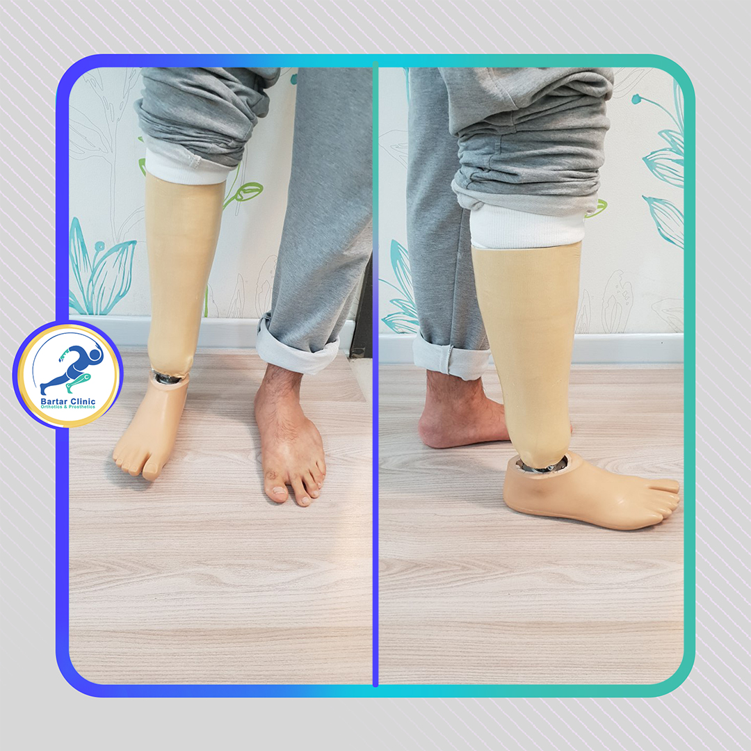Prostheses for Lower Limb
