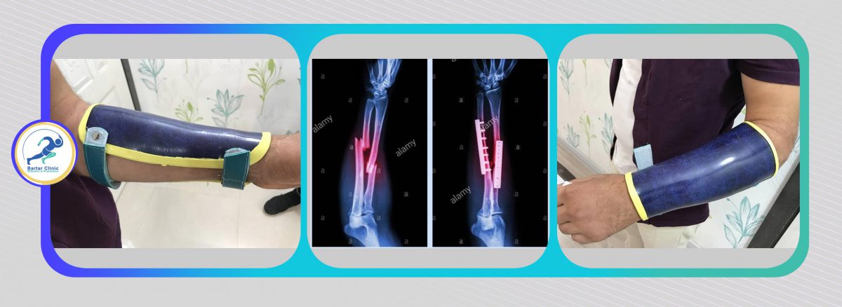 is a fiberglass splint static or dynamic is a fiberglass splint static or dynamic